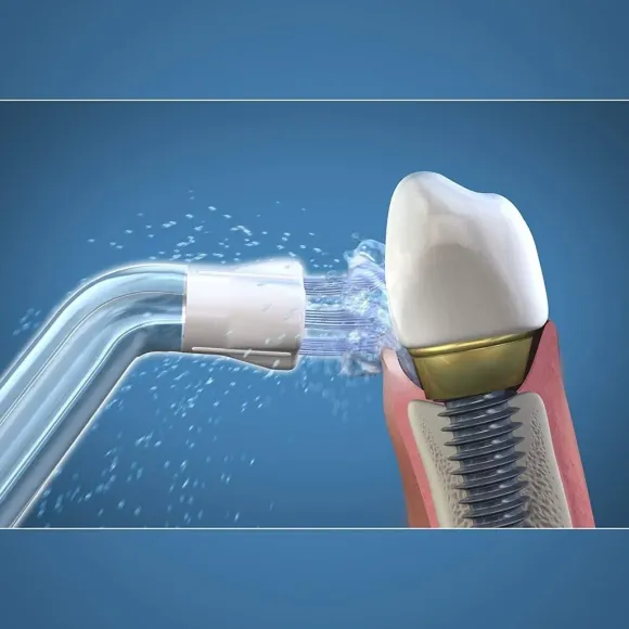 Waterpik WPS-2E końcówki do pielęgnacji implantów, mostów do IRYGATORA WF-05,06 - 2 szuki